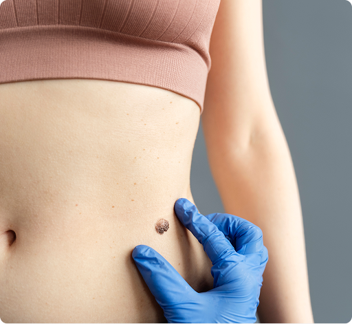 Mole Remover - Little By Little